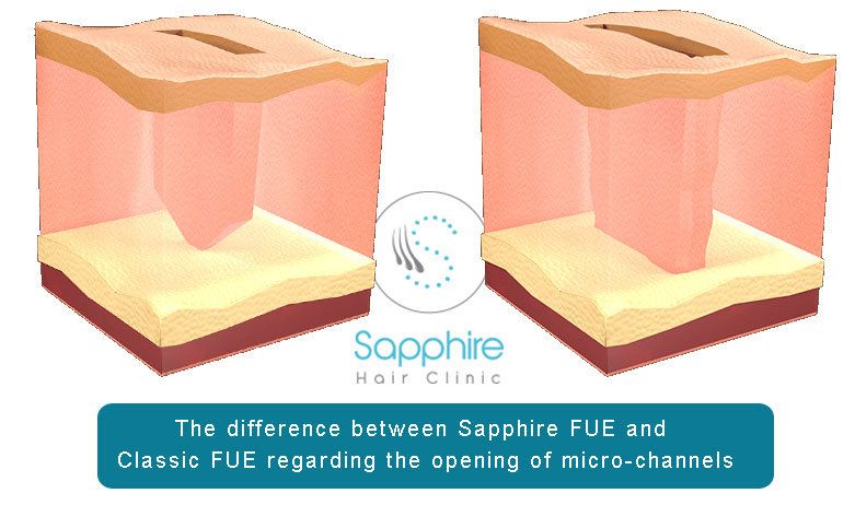 Sapphire FUE Hair Transplant