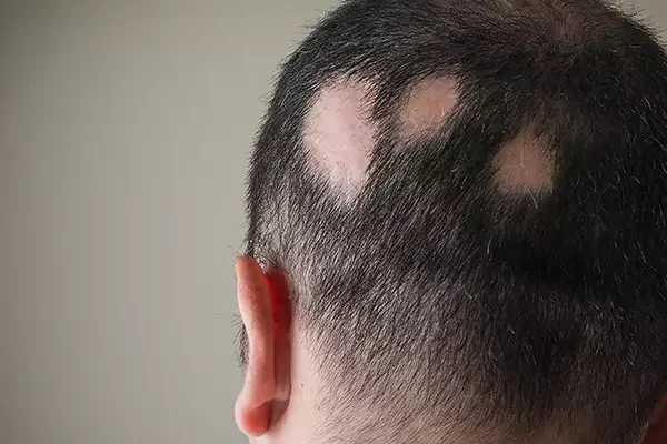 Alopecia Areata