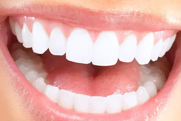 Hollywood Smile Turkey
