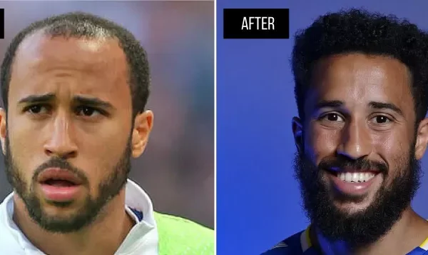 Andros Townsend Hair Transplant