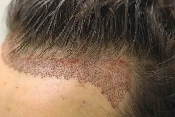 Can I use hair fibers immediately after hair transplantation?