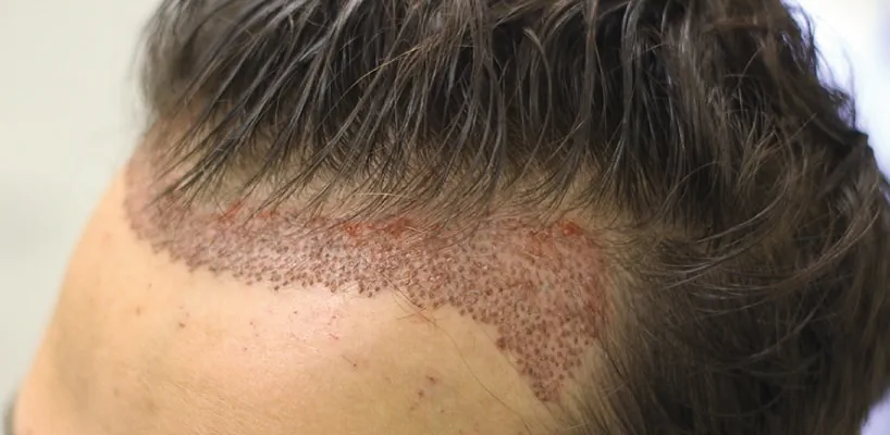 Can I use hair fibers immediately after hair transplantation