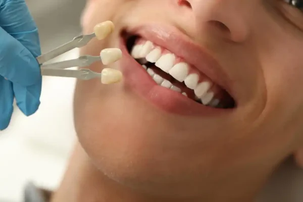Dental Veneers Turkey – Istanbul