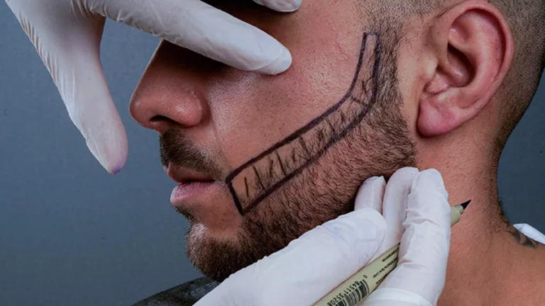 Barttransplantation / Schnurrbarttransplantation