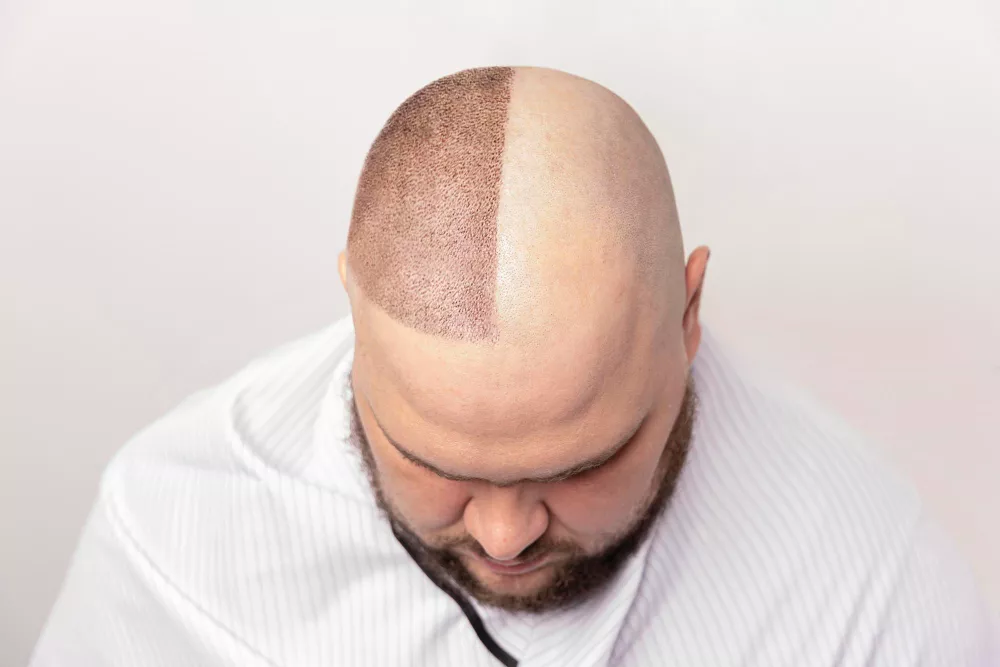 hiv-hair-transplant