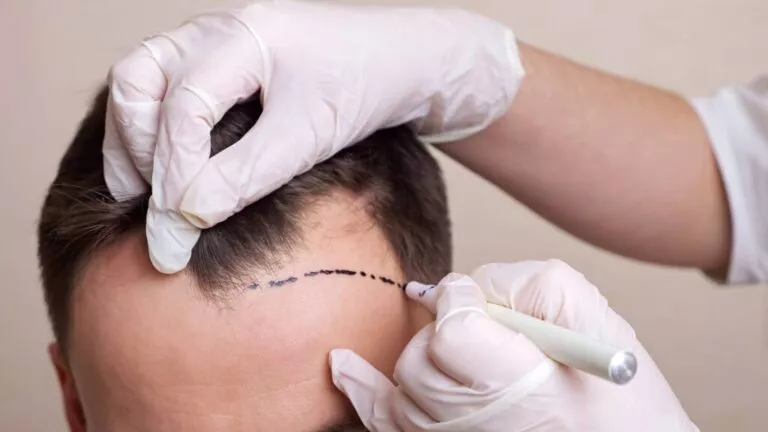Hepatitis C / B Haartransplantation İstanbul