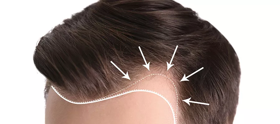 FUE Haartransplantation